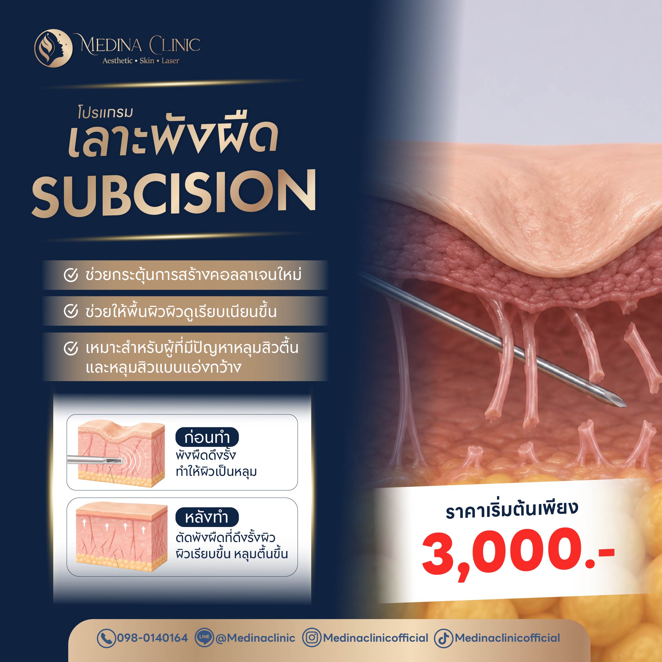 โปรแกรมรักษาหลุมสิว แก้ไขขขข-07