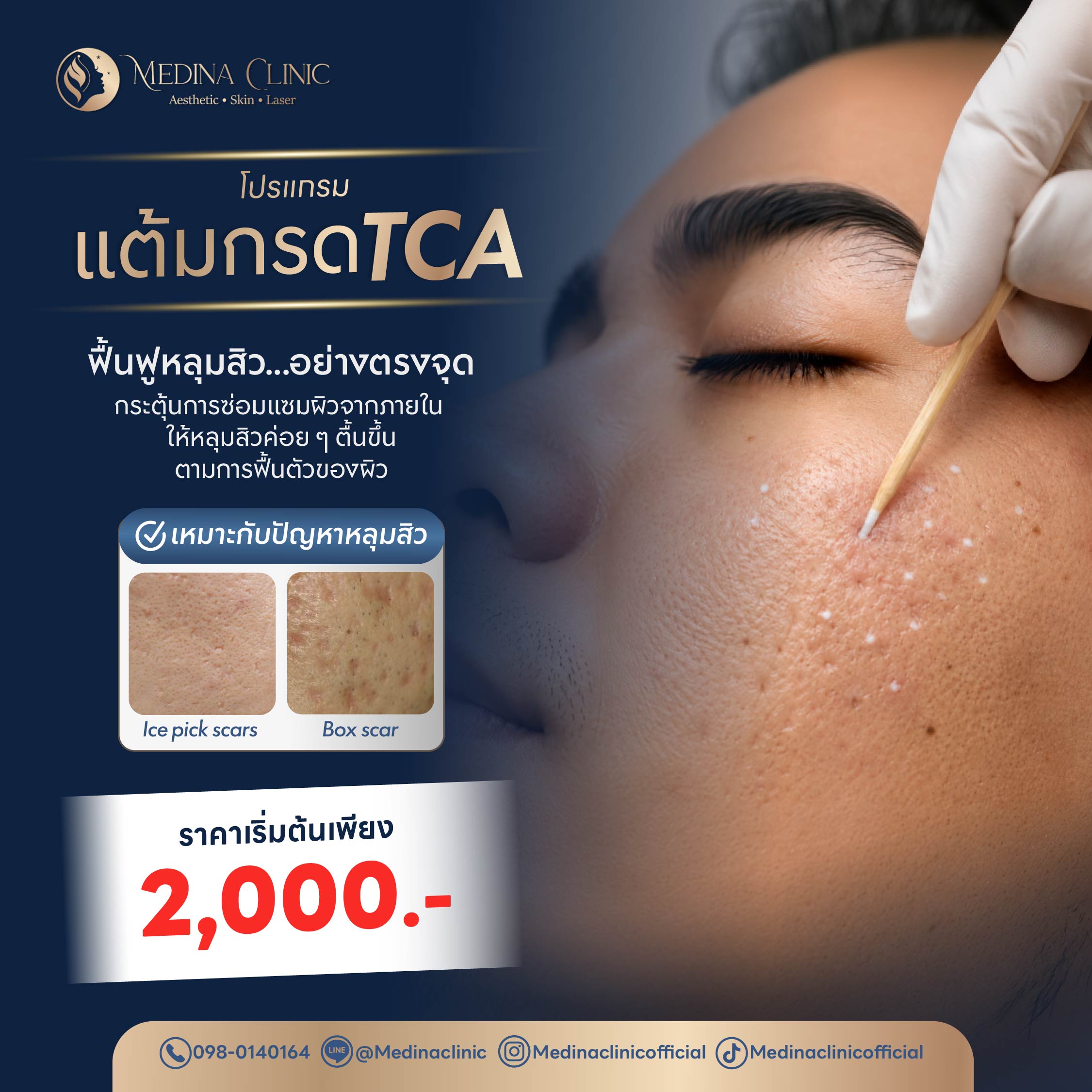 โปรแกรมรักษาหลุมสิว แก้ไขขขข-08